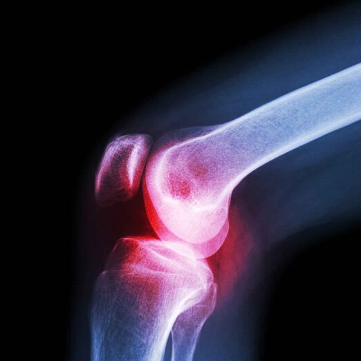 6233 XL Knee Support Cap for Ultimate Knee Support