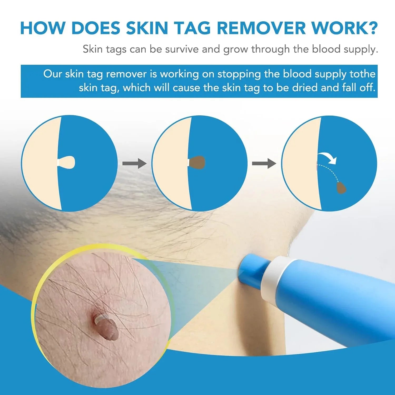 Skin Tag Remover Kit 2 In 1 For Micro To Large (2 Mm - 8 Mm 1 Set) - Zidbik