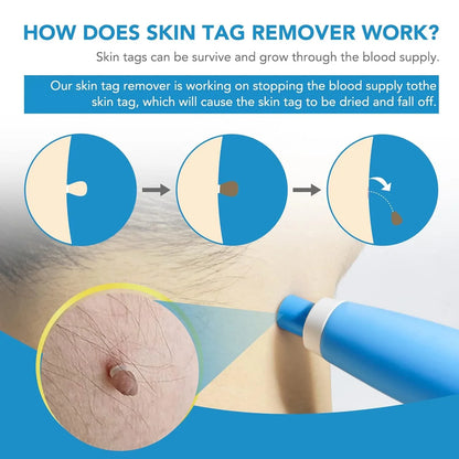 Skin Tag Remover Kit 2 In 1 For Micro To Large (2 Mm - 8 Mm 1 Set) - Zidbik