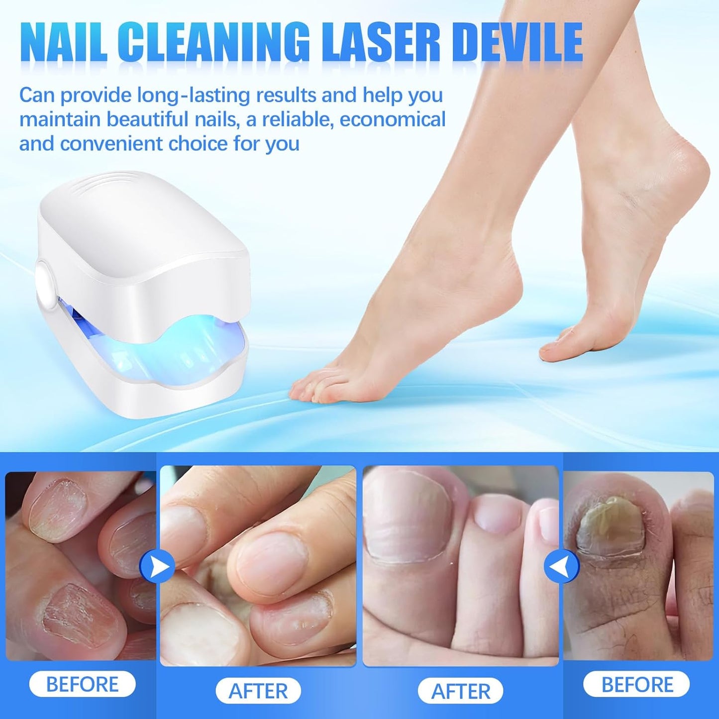 12915 Rechargeable Nail Fungus Treatment For Toenail Toe Nail Fungal Treatment Nail Fungus Laser Device Anti-fungal Nail Treatment For Hand  Feet Infections Remover For Home Use - Zidbik
