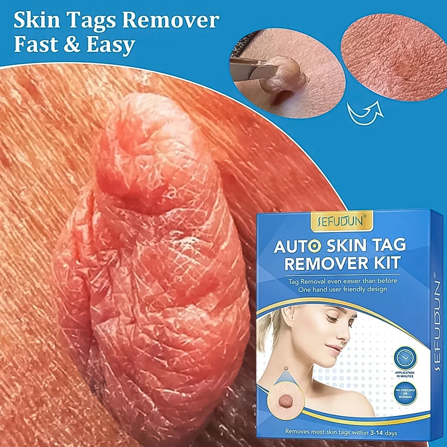 Skin Tag Remover Kit 2 In 1 For Micro To Large (2 Mm - 8 Mm 1 Set) - Zidbik