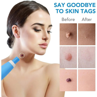 Skin Tag Remover Kit 2 In 1 For Micro To Large (2 Mm - 8 Mm 1 Set) - Zidbik